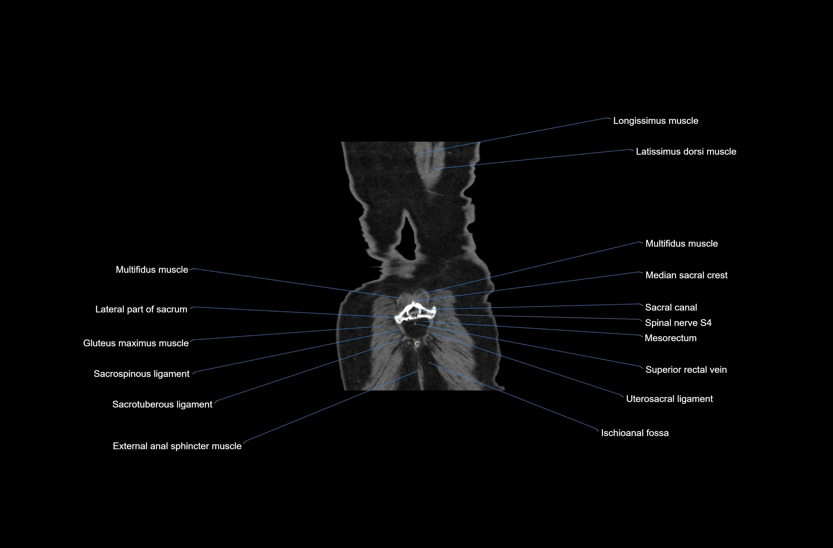CT abdomen coronal cross sectional anatomy labelled radiology image-00081.webp